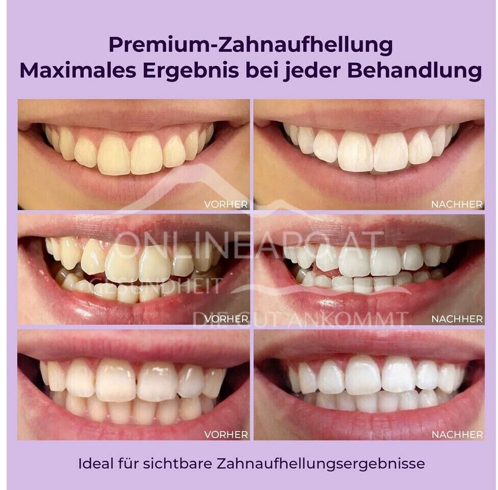 OnlySmile® Zahnaufhellungsgel 40ml