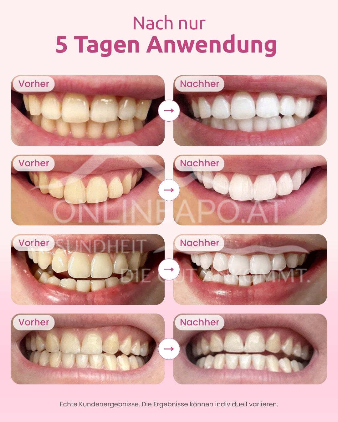OnlySmile® Zahnaufhellungsset